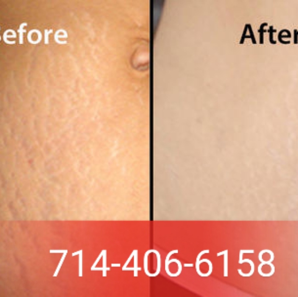Stretch Mark - Dark Spot - Scars Removed